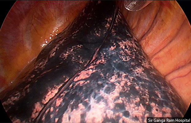Lung Cancer 1