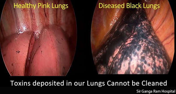 Lung Cancer 2