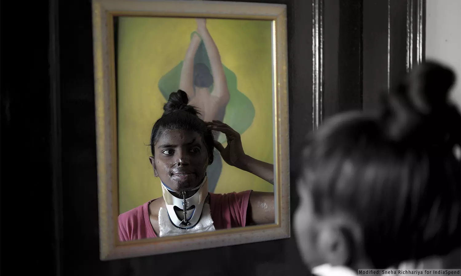 Scare of the Scars: Acid Attacks and Skin Scarring Scare of the Scars: Acid Attacks and Skin Scarring