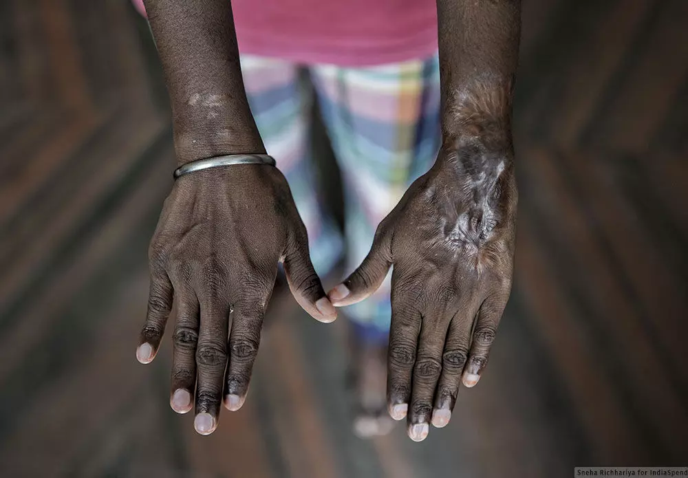 Scare of the Scars Acid Attacks and Skin Scarring