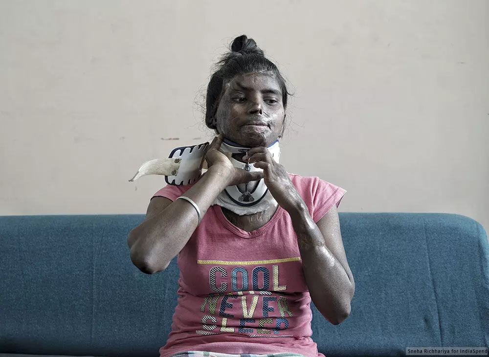 Scare of the Scars Acid Attacks and Skin Scarring