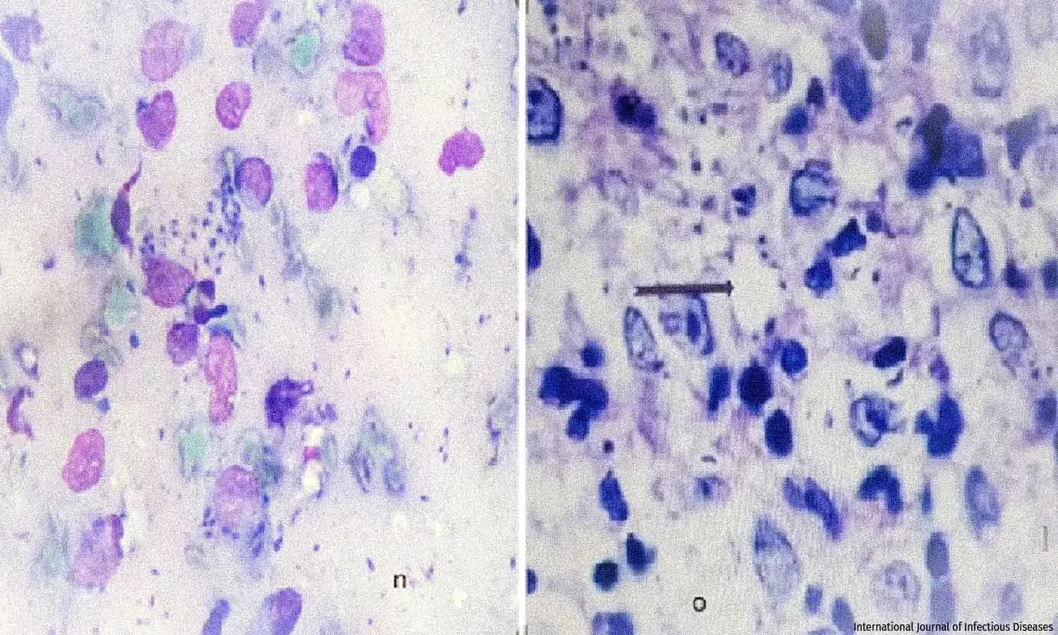 How Jammu & Kashmir Is Seeing More Cases of Leishmaniasis How Jammu & Kashmir Is Seeing More Cases of Leishmaniasis