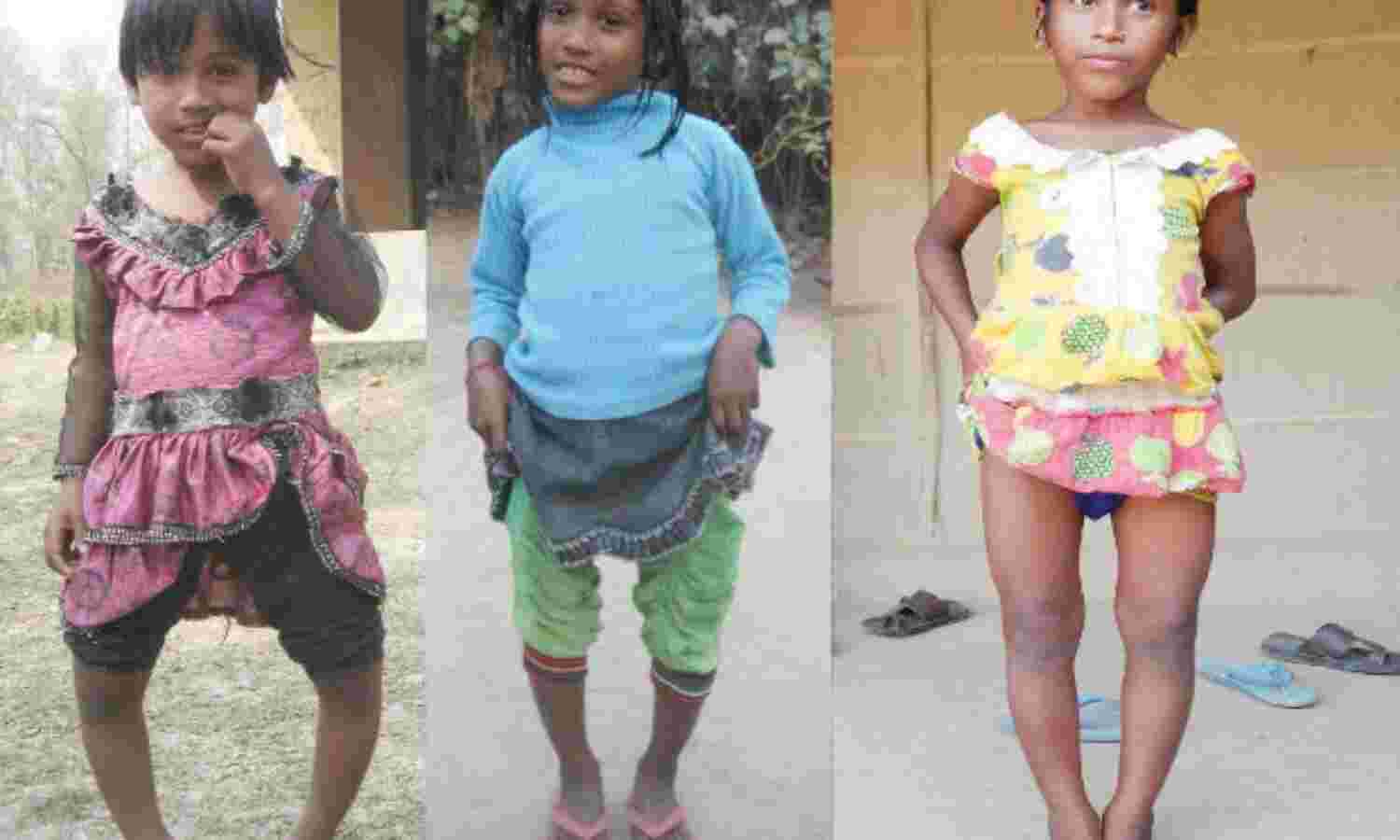 Fluoride Contamination Cripples More Than 1,000 Children In Assam