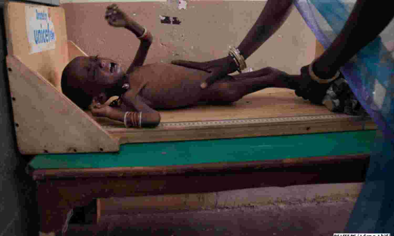 Last 5 Years, Number Of Undernourished Indians Rises
