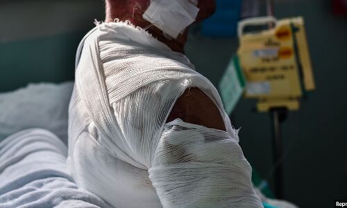 India’s Burn-Care Management Suffers From Lack Of Data, Beds, Trained Medics India’s Burn-Care Management Suffers From Lack Of Data, Beds, Trained Medics