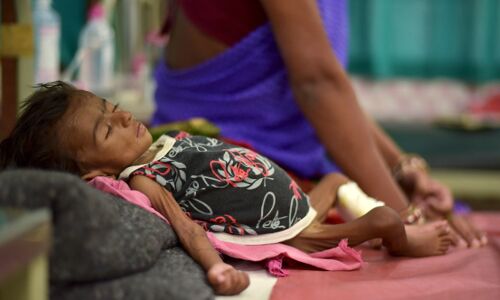 Why Malnutrition Remains A Challenge For India Why Malnutrition Remains A Challenge For India